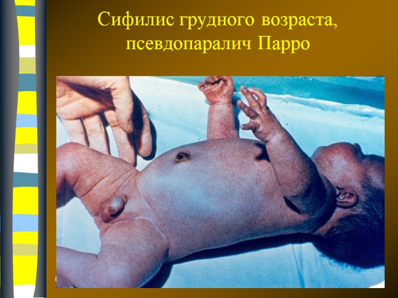 09.12.2017 Сифилис грудного возраста, псевдопаралич Парро